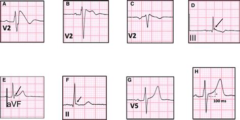 The Utility of Sodium Channel Provocation in Unexplained Cardiac Arrest ...