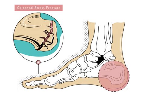 Heel Pain: Causes, Treatment & Prevention | Podiatry Sydney