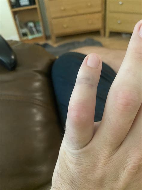 Dislocated my pinky yesterday and now have 3 circle bruises in the ...
