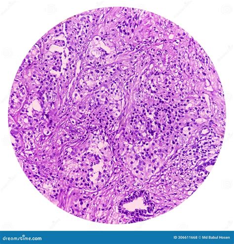 Prostatic Chips (TURP): Adenocarcinoma. it Reveals an Infiltrating Adenocarcinoma. Prostate ...