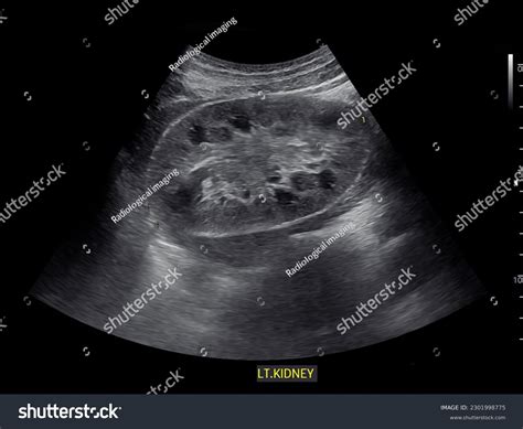 Kidney Stone Ultrasound