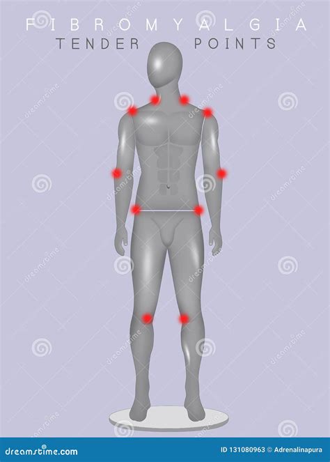 Tender Points Of Fibromyalgia With Pain Location On Body Outline Diagram Cartoon Vector ...