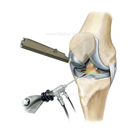 Scope Operation On Knee