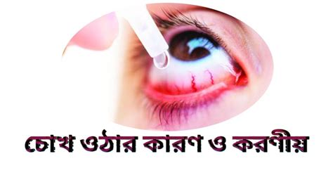কনজাংটিভাইটিস