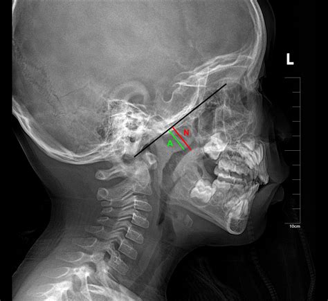 Frontiers | Optimized deep learning model for diagnosing tonsil and adenoid hypertrophy through ...