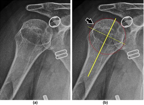 The broken circle method: a novel technique that enhances detection of ...