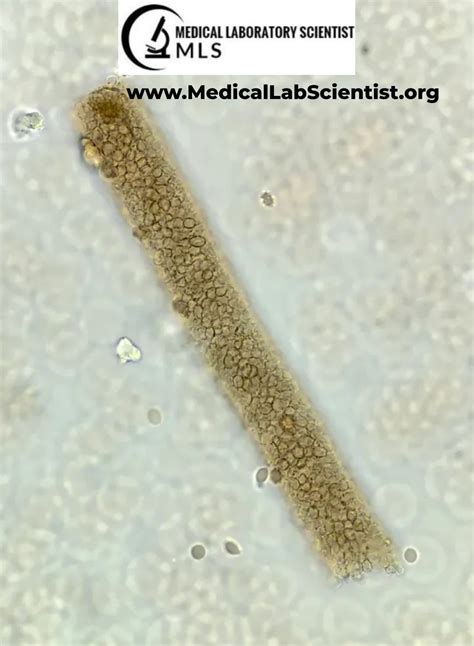 URINARY CASTS: Types, Composition, Significance, Causes, Diagnosis ...