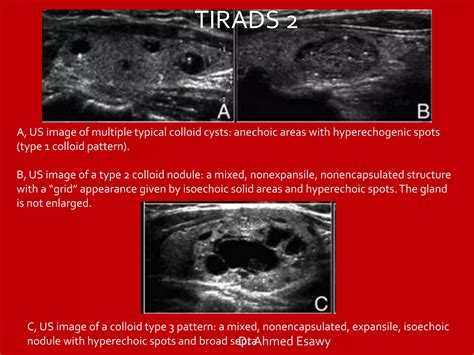 TIRADS (thyroid nodule imaging reporting and data system) Dr Ahmed ...