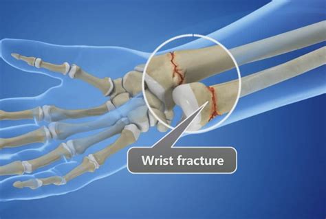 Classification Of Wrist Fractures at Joseph Dearth blog