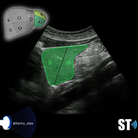 Liver Anatomy Ultrasound Liver Ultrasound Training Liver Anatomy