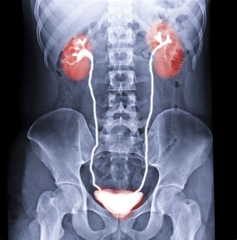 Image result for Normal Intravenous Pyelogram
