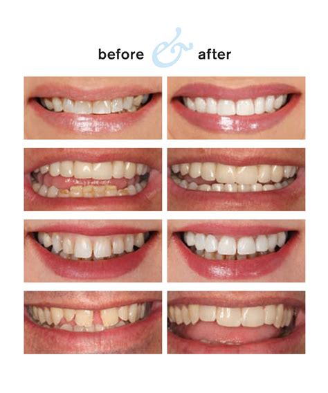 Dental Pearls: Porcelain Veneers in One Hour-New permanent Cerinate Veneers