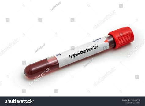Peripheral Blood Smear Test Medical Check Stock Photo 2148428531 ...
