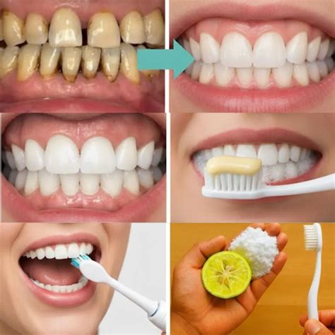 How To Safely Naturally Whiten Teeth Without Damaging Your Enamel