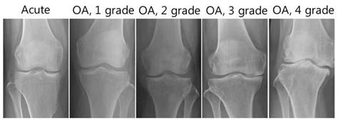 Knee Osteoarthritis - Physiopedia