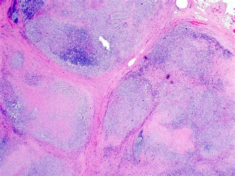 Nodular Sclerosis Hodgkin Lymphoma