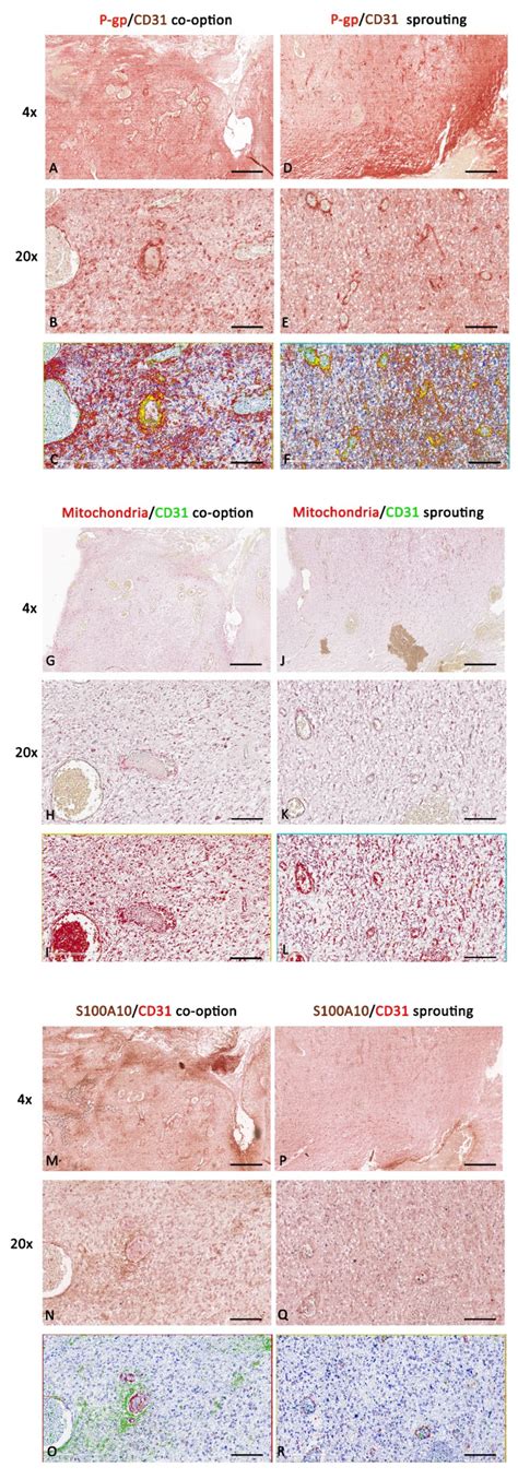 Differential P-Glycoprotein/CD31 Expression as Markers of Vascular Co ...