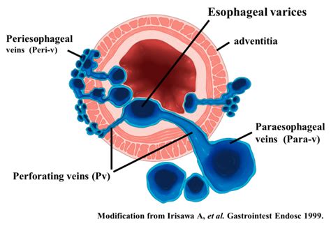 The Role of Endoscopic Ultrasound for Esophageal Varices