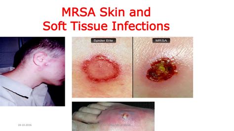 MRSA INFECTIONS basics, implications, and prevention | PPTX