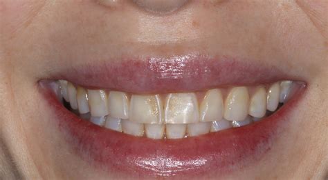 Tooth Discoloration: Causes, Solutions, and Prevention - Pickett Family Dental