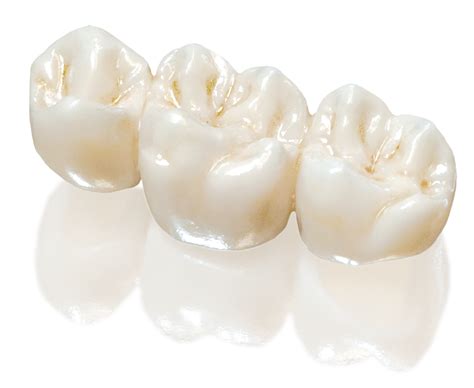 Cementing Zirconia Crowns at Flor Williams blog