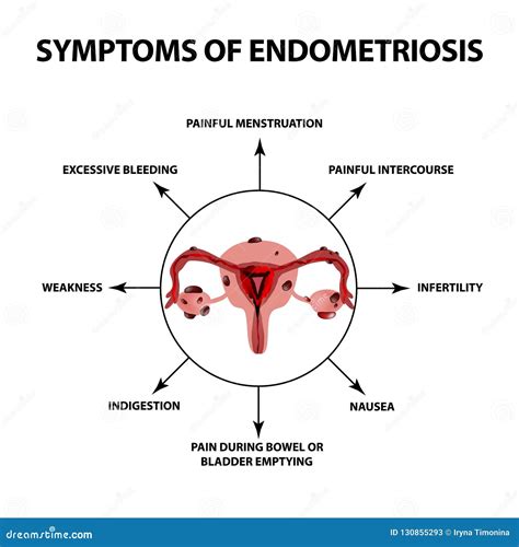 Endometriosis Polycystic Ovaries
