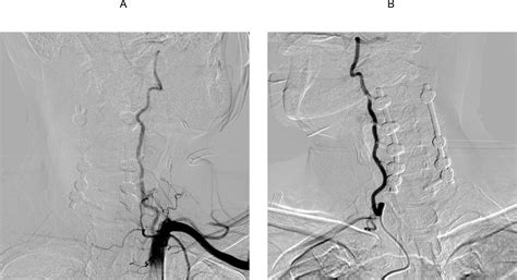 Treatment of rotational/positional vertebral artery occlusion due to degenerative changes in the ...