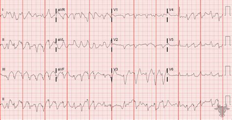 Atrial Fibrillation | ECG Stampede