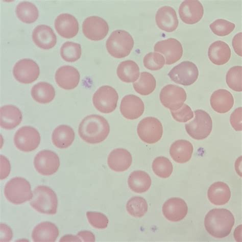 Target Cells: Appearance & Clinical Significance - MedLabBuddy