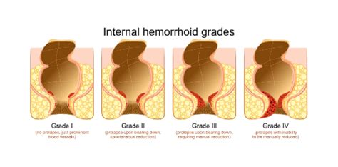 Female Hemorrhoids Hemorrhoid Types – Hemorrhoid Treatment Calgary