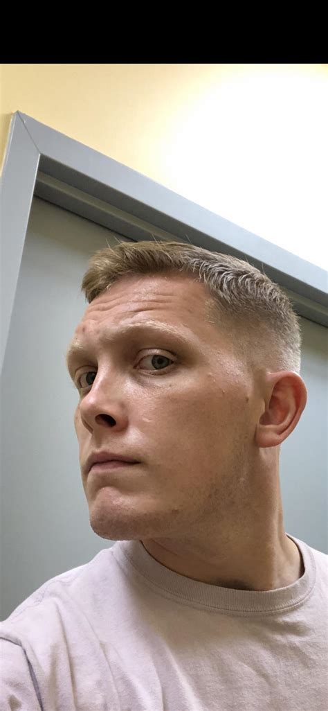 Marfan Syndrome Face