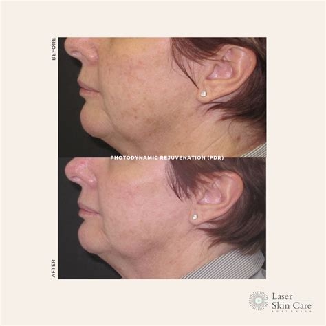 Age Spots & Pigmentation - Laser Skin Care
