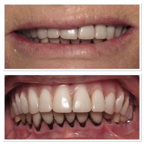 K Michelle Before And After Teeth