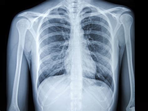 Can Chest X-Rays Really Spot Lung Cancer?