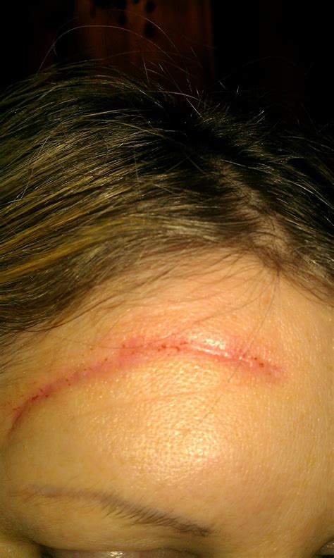 Scar reff. in 2025 | Face scars, Scar on forehead, Burn scars