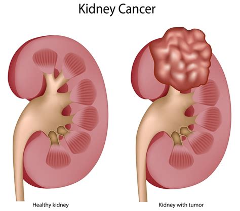 Kidney Cancer - Causes, Symptoms, Signs, Stages & Treatment