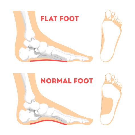 Flat Feet | Foot and Ankle Orthopedics | Seaview Orthopaedics