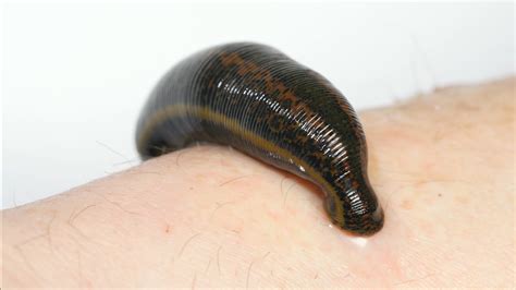 WATCH: See How Leeches Can Be A Surgeon's Sidekick | WAMU