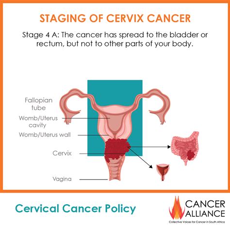 Cervical Cancer Treatment By Stage