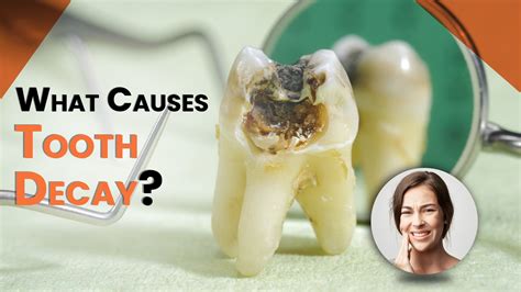 Can Anesthesia Cause Tooth Decay at Darren Pennington blog