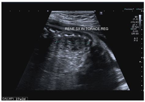 Prenatal Diagnosis of an Intrathoracic Left Kidney Associated with ...