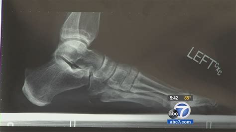 Stress fractures linked to Morton