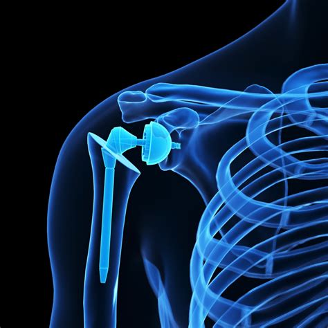 Shoulder Replacement Surgery - Dr. Savla