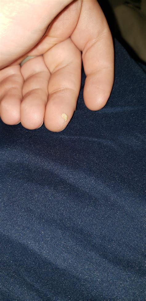 Popping hidden tonsil stones - lopezmove