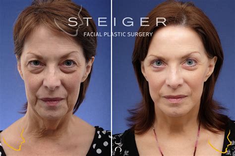 Facelift Before and After Photos | Deep Plane Facelift