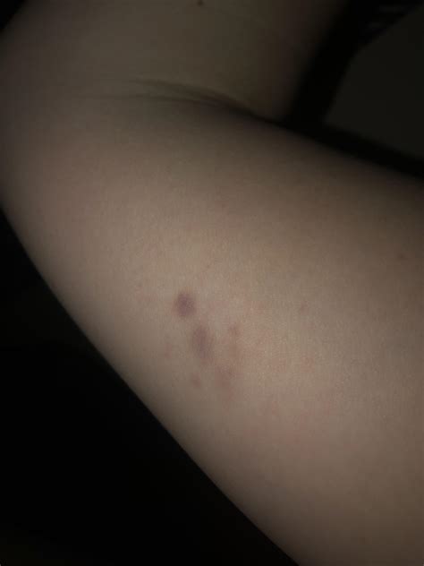 Does Blood Clot Feel Like A Bruise at Sara Gardner blog