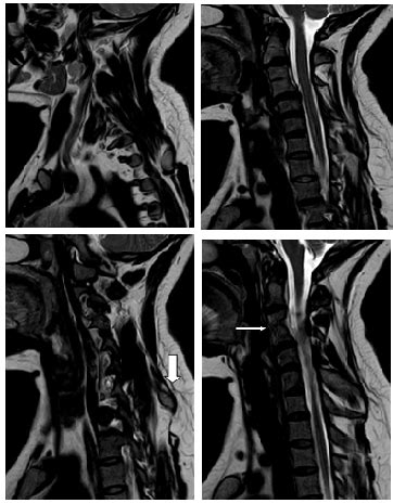 Rare case of unilateral hypertrophy of left lamina and spinous process ...