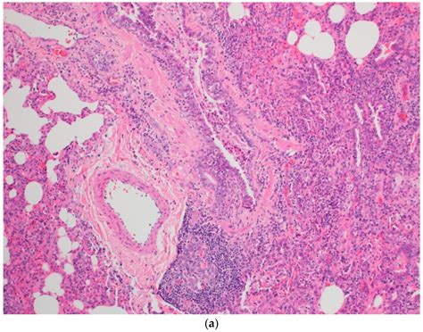 A Rare Pediatric Case of Severe Bird Fancier’s Lung Presented with ...
