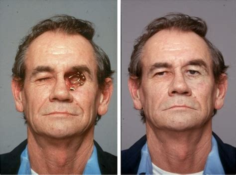 Reconstruction of the Face Following Cancer Ablation | IntechOpen