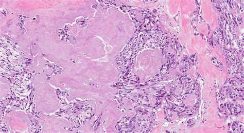 Amyloid | MyPathologyReport